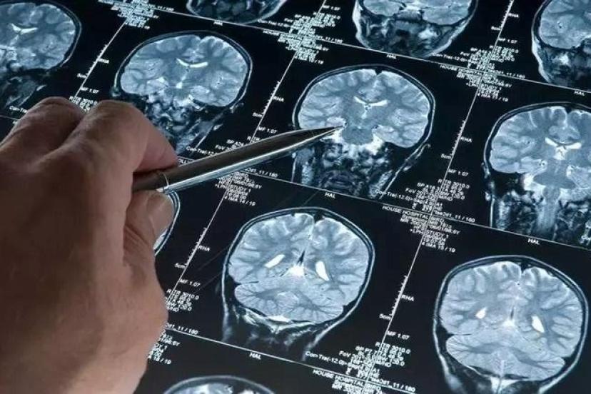 Alzheimer teşhisinde kan testi umudu